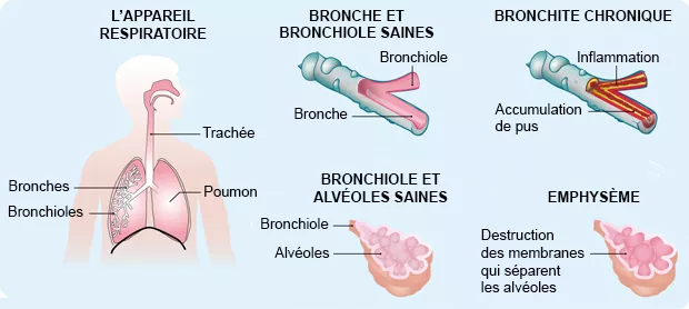 Schéma de la BPCO et des bronches