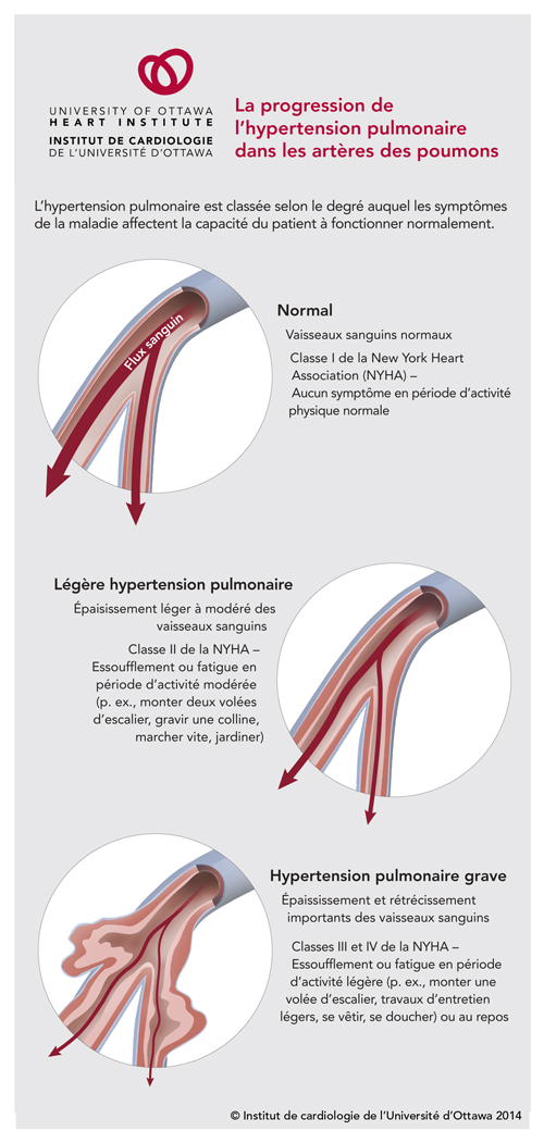 Progression de l'hypertension pulmonaire